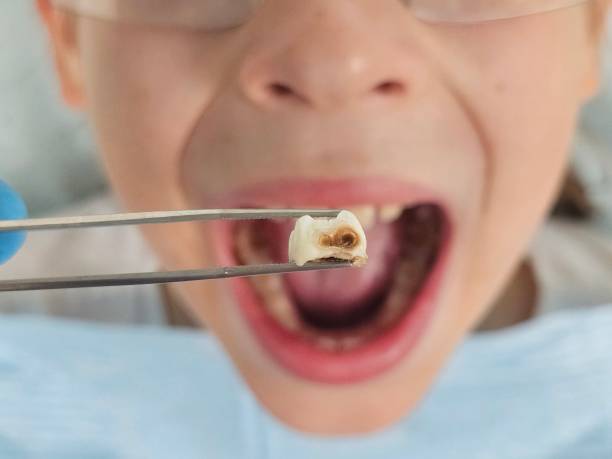Best Broken Tooth Emergency  in Lake Jackson, TX
